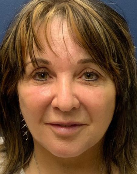 after facelift front view female patient case 982