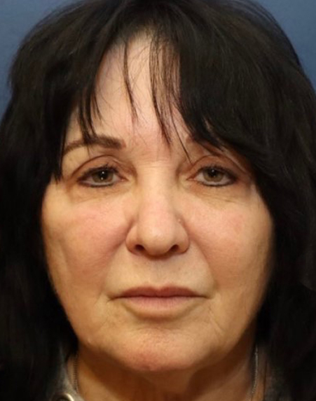 before facelift front view female patient case 982