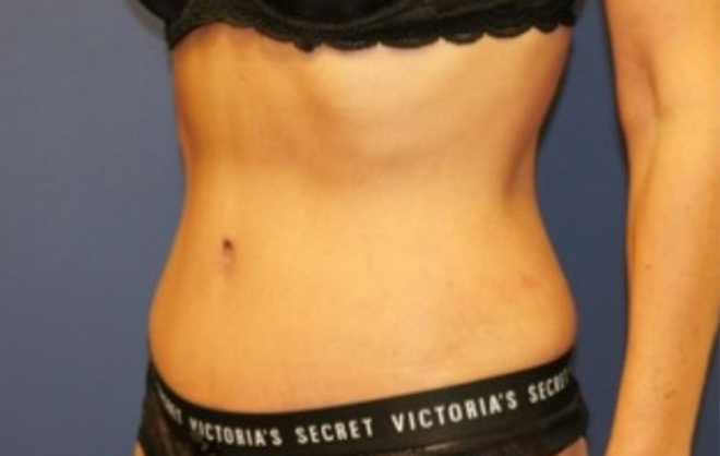 mommy makeover after diagonal view