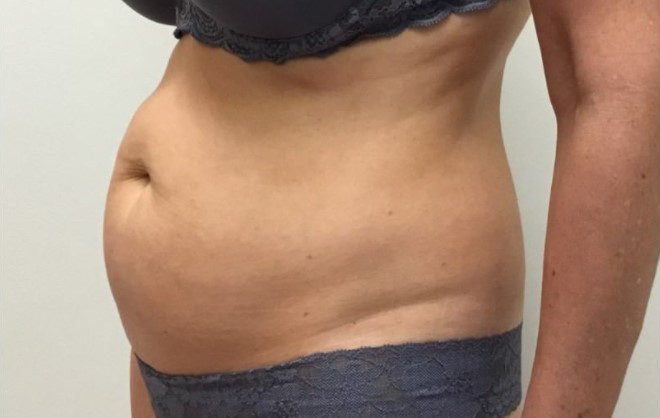 mommy makeover before diagonal view