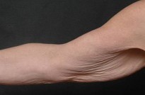 Before arm lift front view female patient case 2817