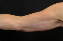 After arm lift front view female patient case 2817