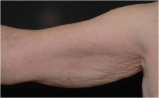 Before arm lift right arm front view female patient case 2829