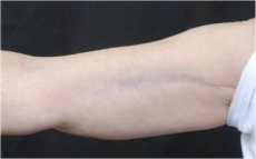 After arm lift right arm front view female patient case 2829