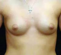 before breast augmentation front view of female patient 2883
