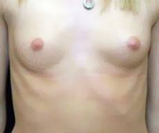 before breast augmentation front view of female patient 2901