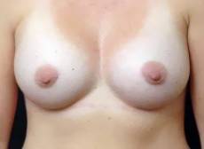 after breast augmentation front view of female patient 2906