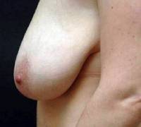 eyelid surgery before side view