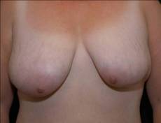Before breast lift front view female patient case 2194