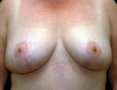After breast lift front view female patient case 2194