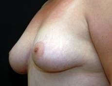 After breast lift left angle view female patient case 2194