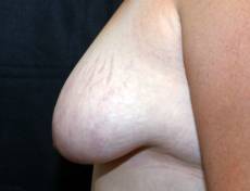 Before breast lift left side view female patient case 2194