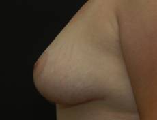 After breast lift left side view female patient case 2194