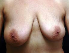 Before breast lift front view female patient case 2202