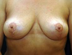 After breast lift front view female patient case 2202