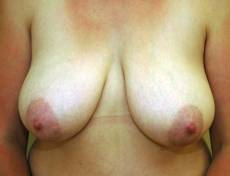 Before breast lift front view female patient case 2206