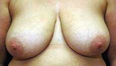 Before breast lift front view female patient case 2209