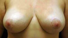After breast lift front view female patient case 2209