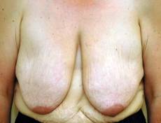 Before breast reduction front view female patient case 2747