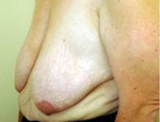 Before breast reduction left side view female patient case 2747