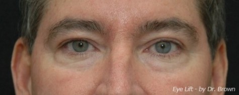 Before eyelid surgery front view male patient case 2761