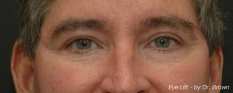 After eyelid surgery front view male patient case 2761