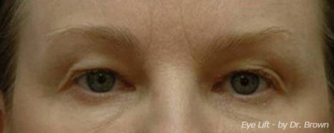 Before eyelid surgery front view female patient case 2786