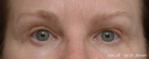 After eyelid surgery front view female patient case 2786