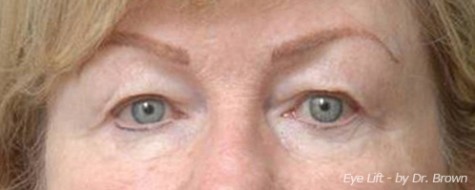 Before eyelid surgery front view female patient case 2789