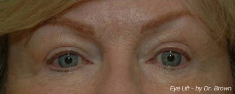 After eyelid surgery front view female patient case 2789