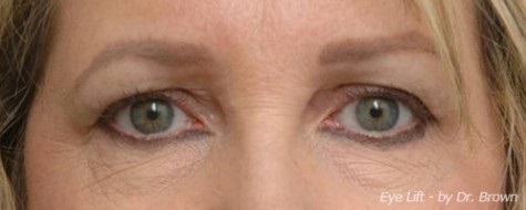 Before eyelid surgery close up front view female patient case 2779