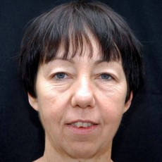 Before facelift front view female patient case 2846