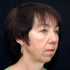 Before facelift right angle view female patient case 2846