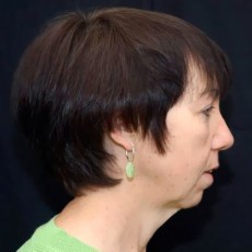 Before facelift right side view female patient case 2846