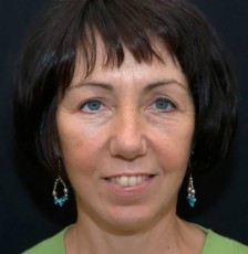 After facelift front view female patient case 2846