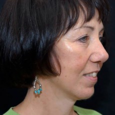 After facelift right angle view female patient case 2846