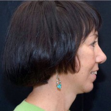 After facelift right side view female patient case 2846