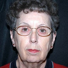 Before facelift front view female patient case 2854