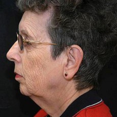 Before facelift left side view female patient case 2854