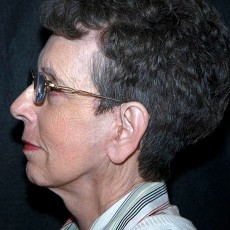 After facelift left side view female patient case 2854