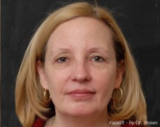 Before facelift front view female patient case 2861