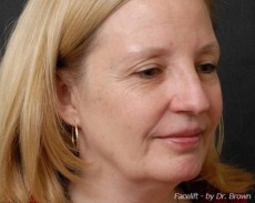 Before facelift right angle view female patient case 2861