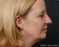 Before facelift right side view female patient case 2861