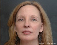 After facelift front view female patient case 2861