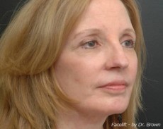 After facelift right angle view female patient case 2861