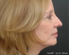 After facelift right side view female patient case 2861