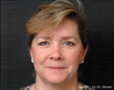 Before facelift front view female patient case 2869