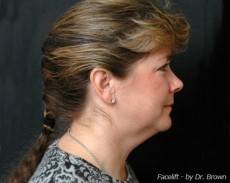 Before facelift right side view female patient case 2869