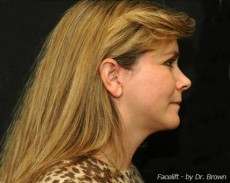 After facelift right side view female patient case 2869