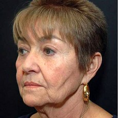 Before facelift left angle view female patient case 2875